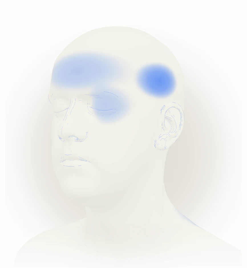 The 3D head at a three-quarter angle: the left temple densest, the forehead and left eye softer